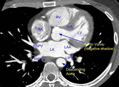 Cardiac CT Scan